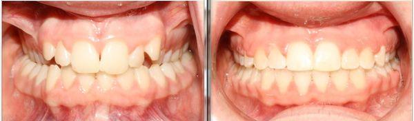 Crossbite before and after