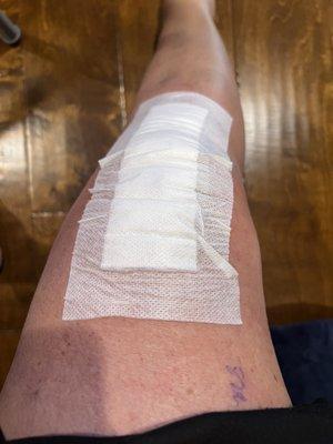 Post op photo of right nano knee procedure