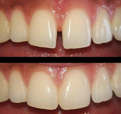 Clear Aligners, Cosmetic Veneers