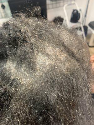 Ex. Scalp Dermatitis before treatment