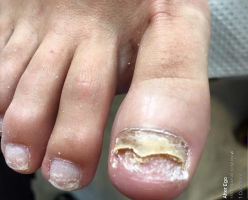 TOENAIL RECONSTRUCTION         Before  reconsruction