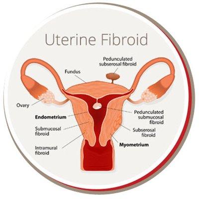 Uterine Fibroid