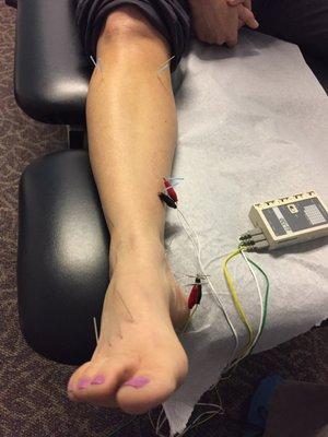 Plantar Fasciitis.  Jump Start the recovery process with Trigger Point Dry Needling