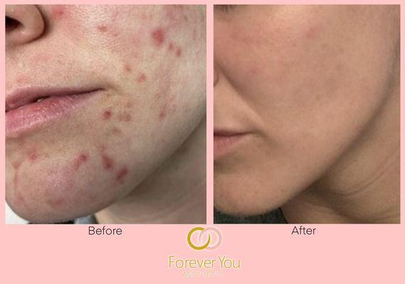 Before & After - IPL acne treatment