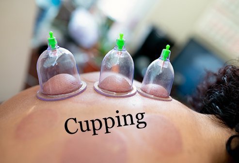 Massage Cupping