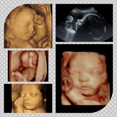 Sweet Pea 3D4D Ultrasound and Photography