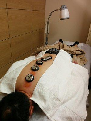 Moxibustion