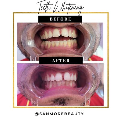 Teeth Whitening Before and After