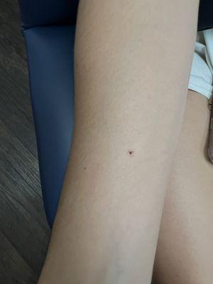 That's the TB skin  test that was given to my daughter!