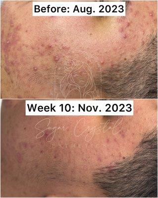 Acne bootcamp progress - receiving treatments every 2-3 weeks plus consistent home care