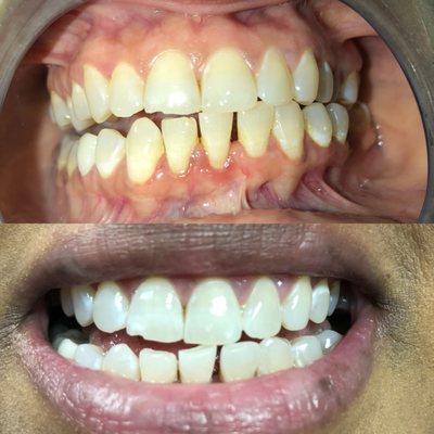 Double Whitening Session 2-twenty minute sessions