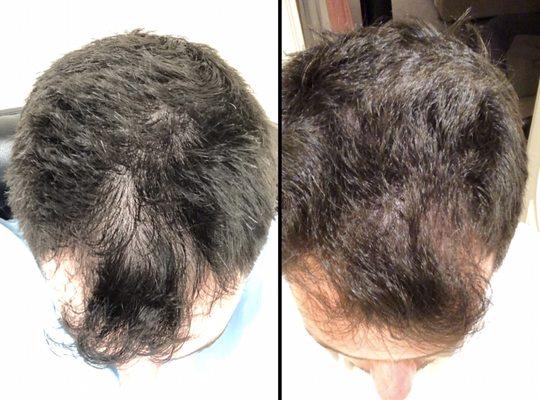 Before and after 3 PRP hair restoration treatments!