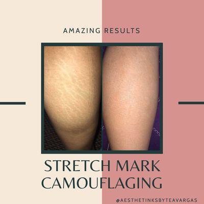 Before and after stretch mark camouflaging package.