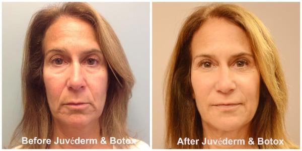 Botox Juvederm Fillers