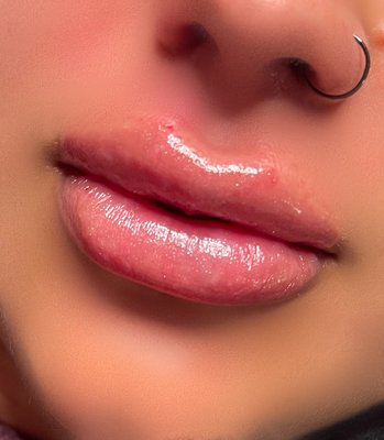 Lip Filler