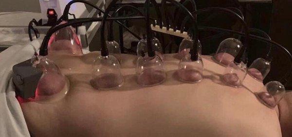 Cupping