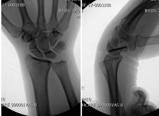 Percutaneous screw fixation of a scaphoid fracture