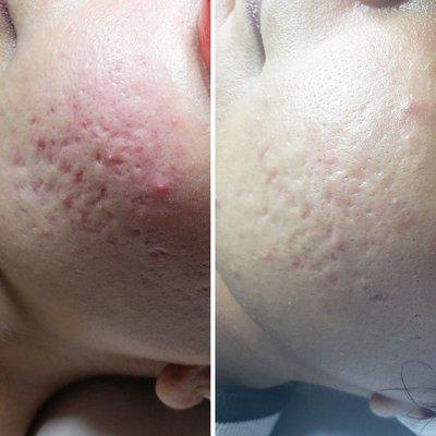 Before and after with consistent corrective treatments