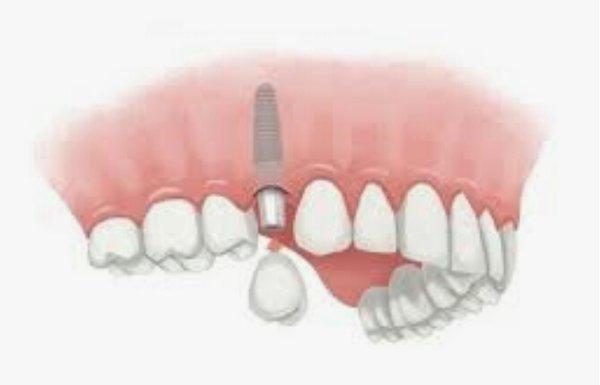 Affordable Dentures & implants - South County