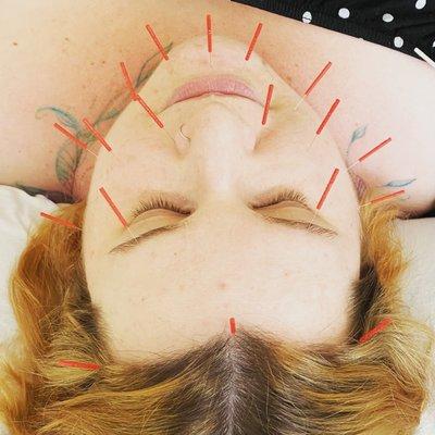 Facial rejuvenation acupuncture is a natural and effective way to enhance collagen production without chemicals, toxins, or fillers.