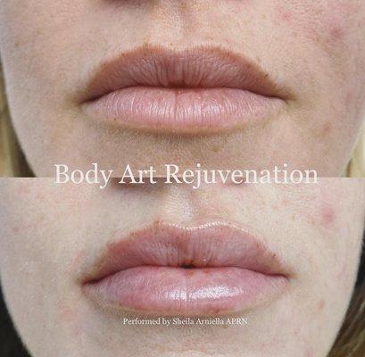 Before and right after lip filler injection. Performed by Sheila Arniella NP.