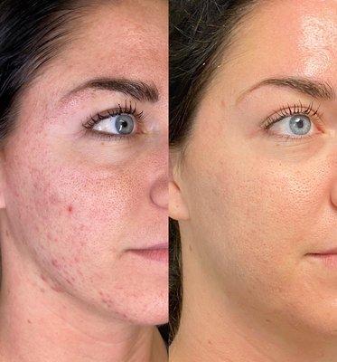 Before and 7 weeks after starting Acne Bootcamp