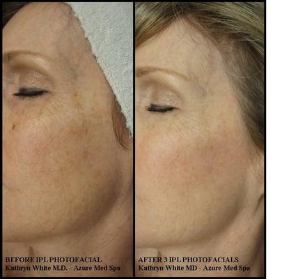 Before and After IPL Photofacial Treatments