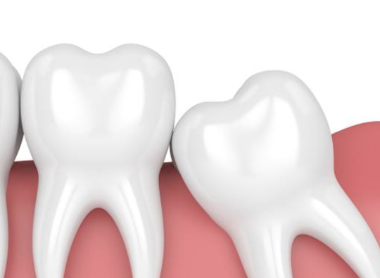 Tooth extraction may be necessary if a tooth has severe decay, periodontal disease, irreparable damaged, or is impacted...