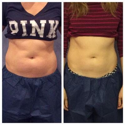 Before & After : Just one month after first Lipo Freeze Session