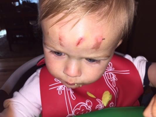 Aso's antibacterial pads (marketed under the Walgreens brand) caused burns/scarring on either side of the forehead of our one year old son.