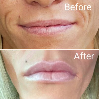 Lip Augmentation