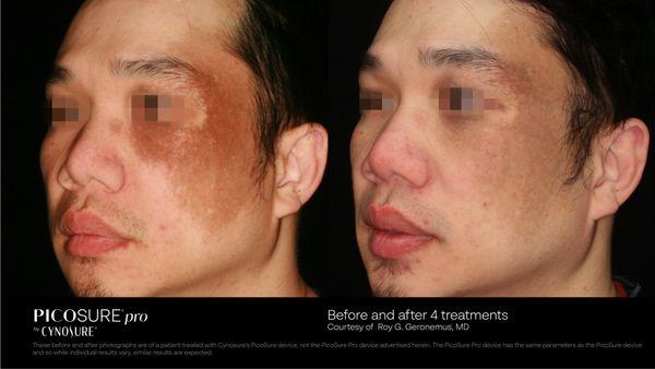 Before and after treatment for Horis nevus