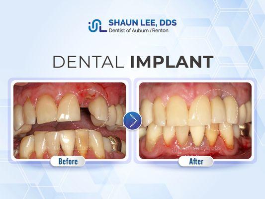 Shaun Lee, DDS Family Emergency Dental Implants of Auburn | 1320 8th St NE Ste. 103, Auburn, WA 98002 |(253)939-3440