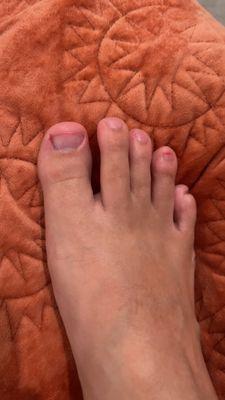 Swollen big toe and ring toe.