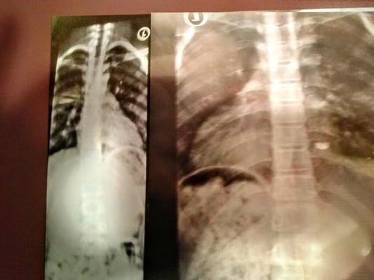 Dr. Clay Robert Miller repairs scoliosis and a lifetime of pain!