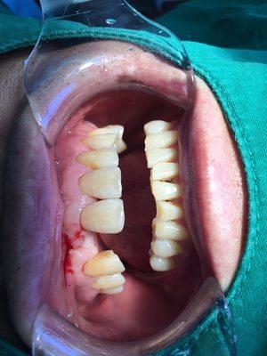 Missing tooth restoration