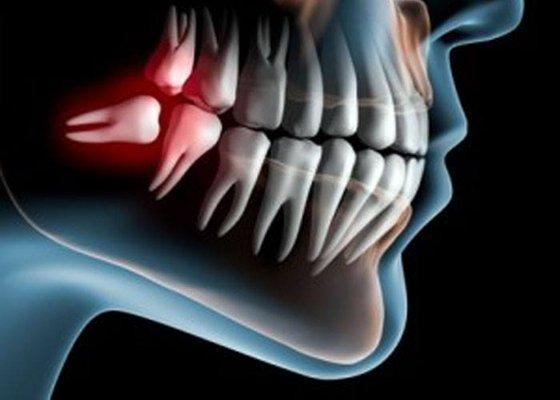 Your wisdom teeth are the four extra molars that grown in when you're around age 18.