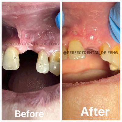 Ridge augmentation and bone graft