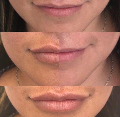 Lip Correction using Juvederm Ultra XC