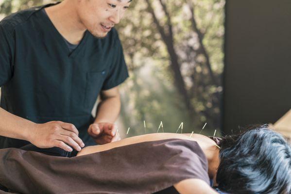 Acupuncture