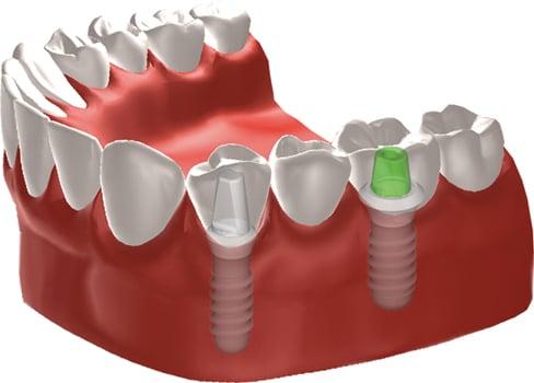 Implant Bridge