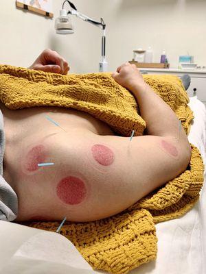 Acupuncture and cupping treatments for shoulder pain from previous sports injury