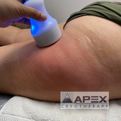 TShock Cellulite Treatment