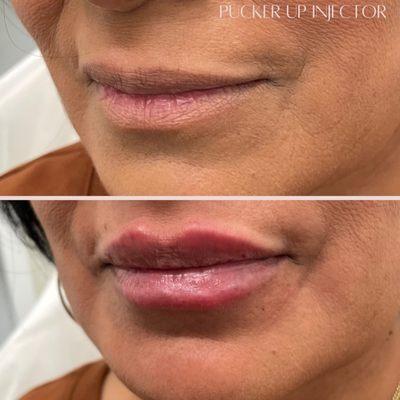 Enhance, enchant, empower. Lip filler love.