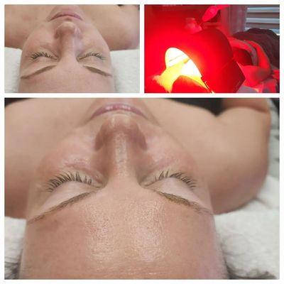 Hydrafacial Syndeo