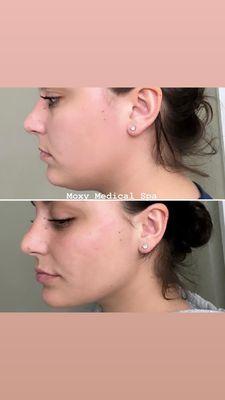 Check and jawline filler for contour and balance