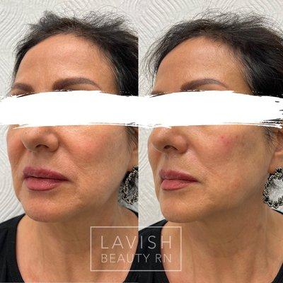 Restylane Lyft cheek filler before and after