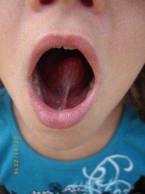 Tongue-tie evaluation