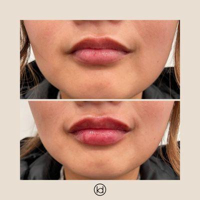 Perfect Pout lip filler enhancement at KD Aesthetics in Bowling Green KY