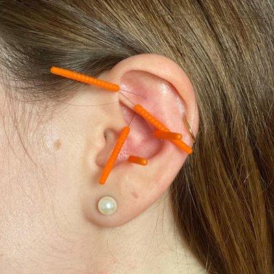 Auriculotherapy or Ear Acupuncture is beneficial for stress, anxiety, pain, addiction, and more!